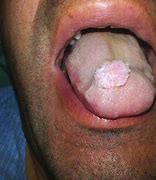 Image result for Verruca Vulgaris Mouth