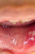 Image result for HPV On Tip of Tongue