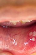 Image result for Papilloma Wart Tongue