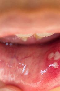 Image result for Verrucous Papilloma