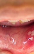 Image result for HPV Tongue Lesion