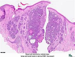 Image result for Infundibulocystic Basal Cell Carcinoma