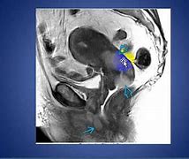 Image result for Genital Cyst