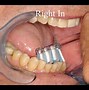 Image result for Modified Bass Tehcnique Brushing
