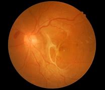 Image result for Ablatio Retina Hole
