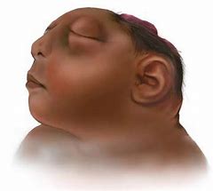 Image result for Meroencephaly