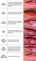 Image result for Genital Warts in Mouth