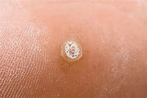 Image result for Warts and Verrucas