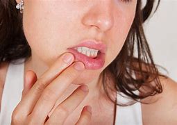 Image result for Food Allergy Lips