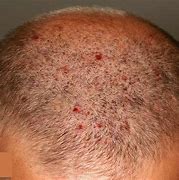 Image result for Bacterial Folliculitis