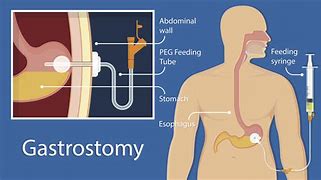 Image result for Feeding Tube Infection Symptoms