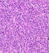 Image result for Biphasic Synovial Sarcoma