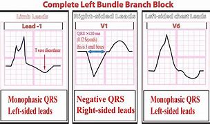 Image result for Left Bundle Branch Block Pattern