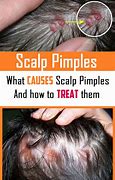 Image result for Pimples On Head Scalp