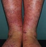 Image result for Actinic Keratosis Legs