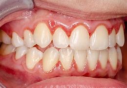 Image result for Papilloma on Gums