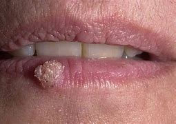 Image result for Small White Warts in the Mouth