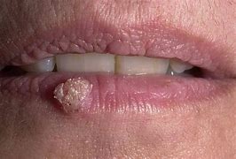 Image result for Human Papillomavirus Lips
