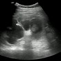 Image result for 1 Cm Kidney Stone