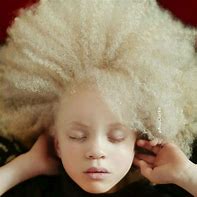 Image result for Albino SunBurn