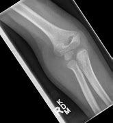 Image result for Elbow Fracture Splint
