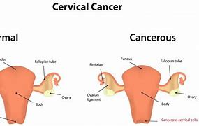 Image result for Cervical Cancer Symptoms 3C1