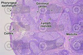 Image result for adenoloy�a
