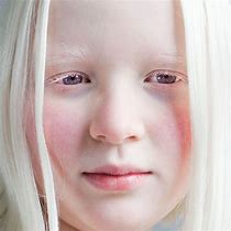 Image result for Albino People Eyes