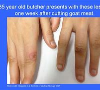 Image result for ORF Lesion