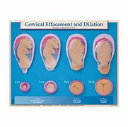 Image result for Cervical Dilation Medical Images Pregnancy