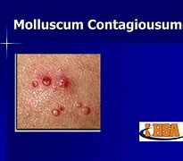 Image result for Molluscum Contagioso