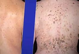Image result for Brown Scaly Spots On Skin