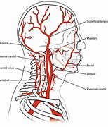 Image result for Carotid Artery Dissection