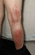 Image result for Scabies Rash Behind Knees