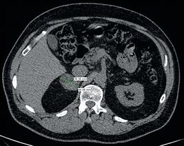 Image result for Hounsfield Units Adrenal Adenoma