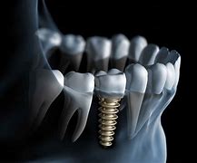 Image result for Implant Cist