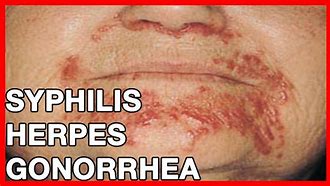 Image result for Gonorrhea On Lips