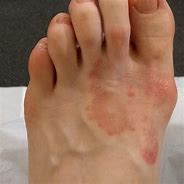 Image result for Skin Conditions On Feet