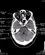 Image result for CT Scan Brain Anatomy