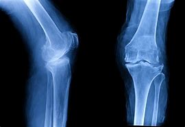Image result for Osteoporosis Knee