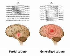 Image result for Seizure Epilepsy Brain