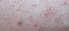 Image result for Eczema vs Keratosis Pilaris