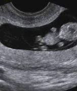 Image result for 9 Weeks Pregnant 4D Ultrasound