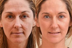 Image result for Laser Skin Treatment