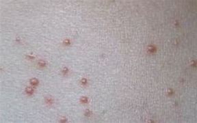 Image result for HPV 疣