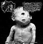 Image result for Cyclocephaly