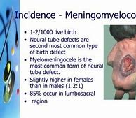 Image result for Lumbar Meningomyelocele
