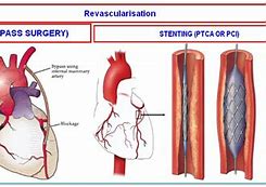 Image result for Heart Bypass Surgery Book