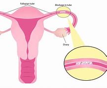 Image result for Blocked Fallopian Tube Symptoms