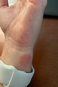 Image result for Allergic Reaction to Apple's